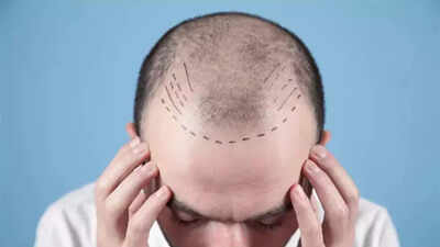 Days after TN order, doctors seek similar rules nationwide as hair transplant boom raises safety alarm | India News