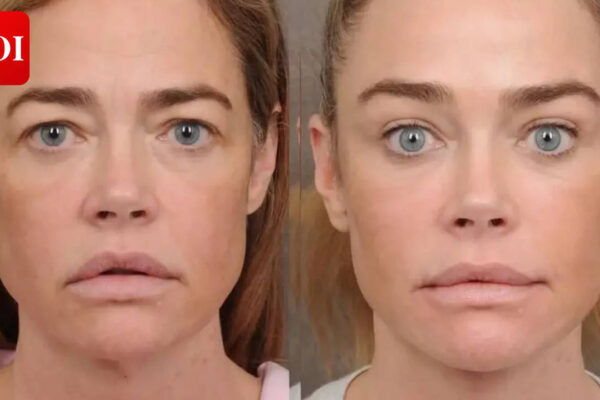 Denise Richards opens up about facelift; surgeon hails actress for bravely sharing 'before and after' pics of work done on forehead, eyes, mouth, neck |