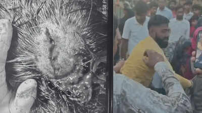 Attempt to save injured dog turns violent in Faridabad; rescuer critical, undergoes emergency surgery | Gurgaon News