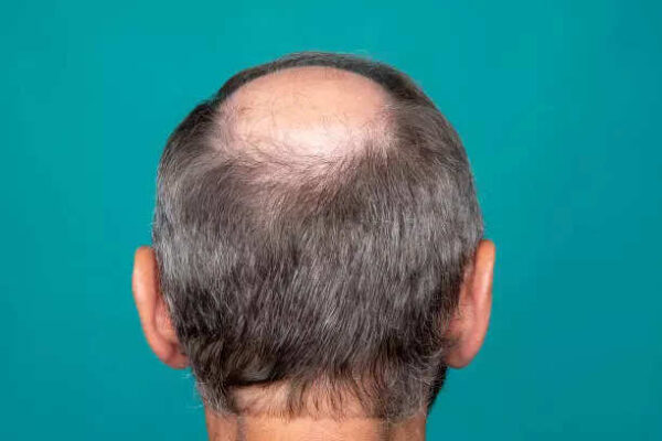 Hair Loss: Men across India are going bald - but researchers say the real reason may shock you
