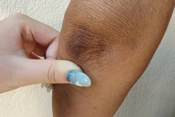 Where Acanthosis Nigricans can hide