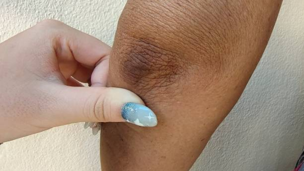 Where Acanthosis Nigricans can hide