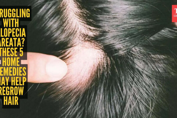 5 sure-shot home remedies that help in hair regrowth in people suffering from Alopecia Areata