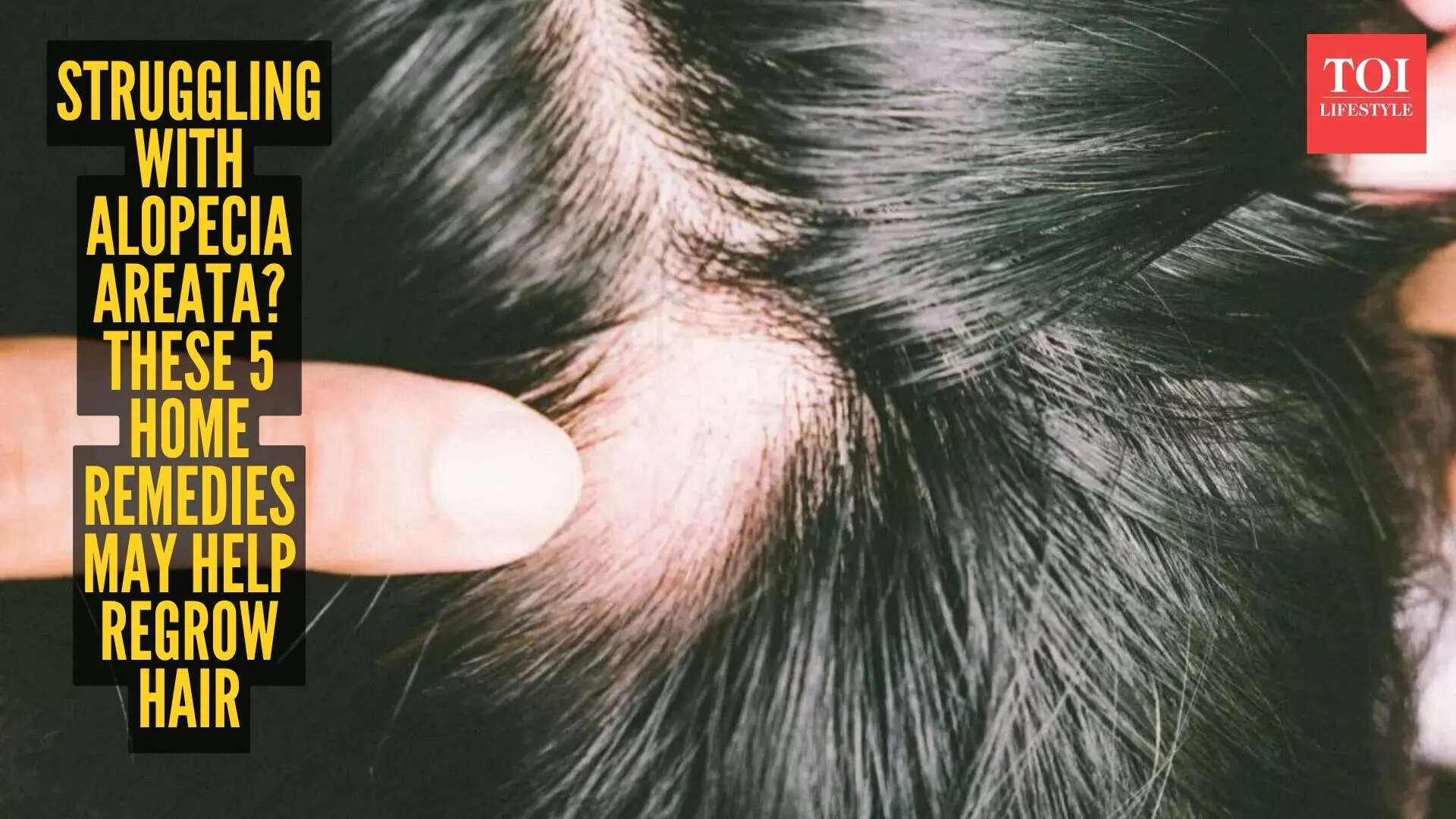 5 sure-shot home remedies that help in hair regrowth in people suffering from Alopecia Areata