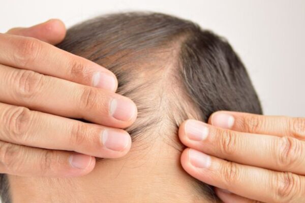Reverse male pattern baldness: Home remedies for hair regrowth in balding men