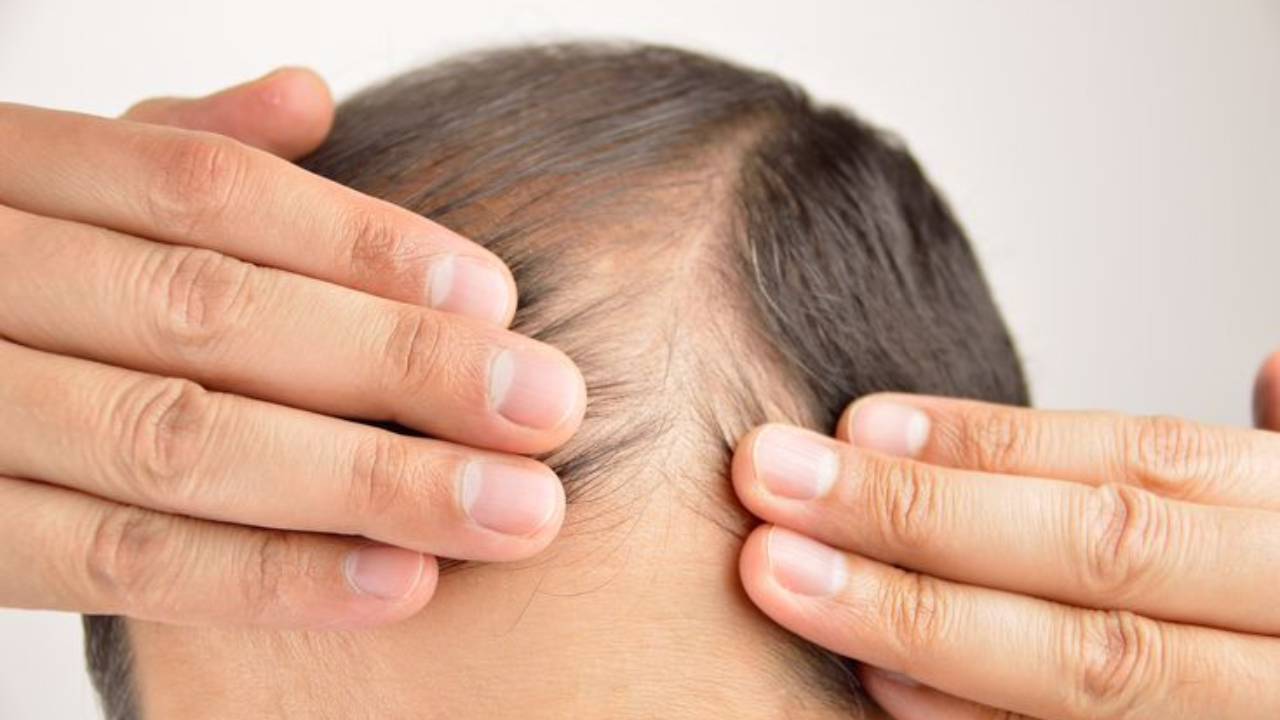 Reverse male pattern baldness: Home remedies for hair regrowth in balding men