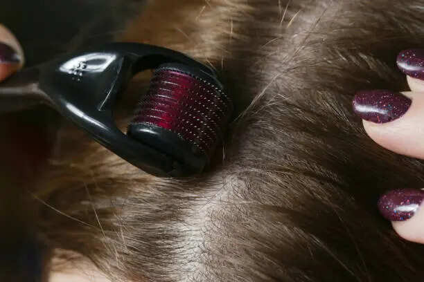 How To Stop Hair Fall: How to reverse hair loss with microneedling and rosemary oil