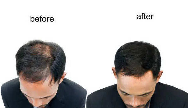 Scalp Massage For Hair Regrowth: Hair regrowth: How to do the best scalp massage for hair regrowth in bald spots