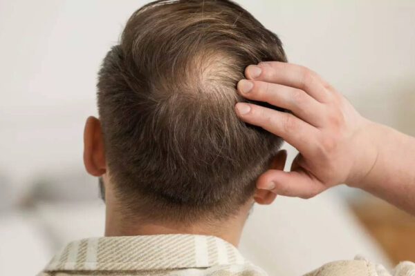 Protein to iron: 5 nutritional deficiencies that can lead to bald spots and hair loss