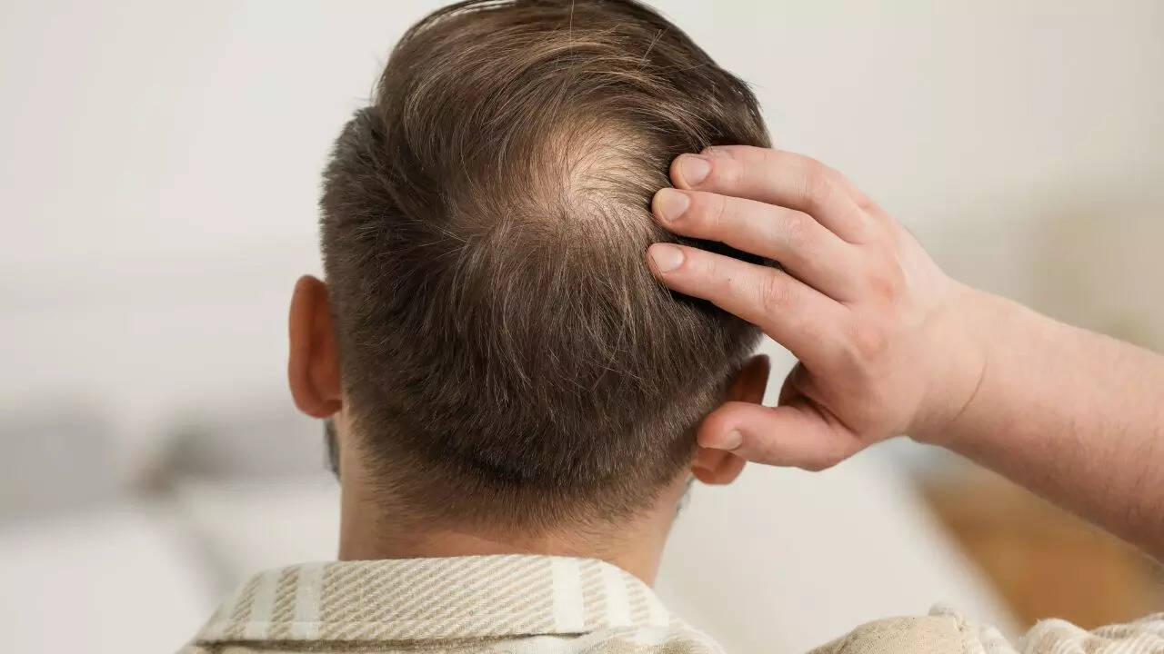 Protein to iron: 5 nutritional deficiencies that can lead to bald spots and hair loss