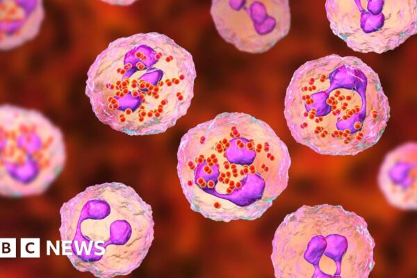 One dead and two ill after meningitis cases in Reading