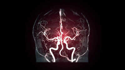 Cerebral Angiography: 7 silent warning signs that may mean you need a Cerebral Angiography