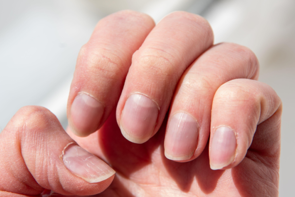 What your fingernails may reveal about health