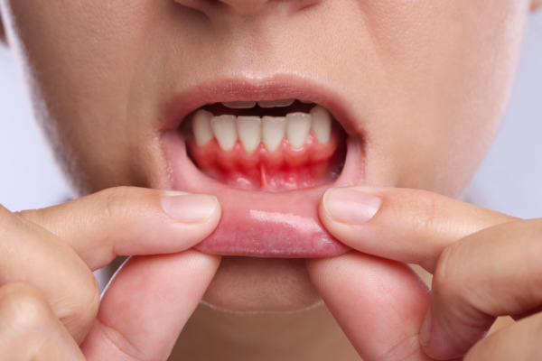 The body check: Why your gums bleed while brushing: What your mouth may be trying to tell you