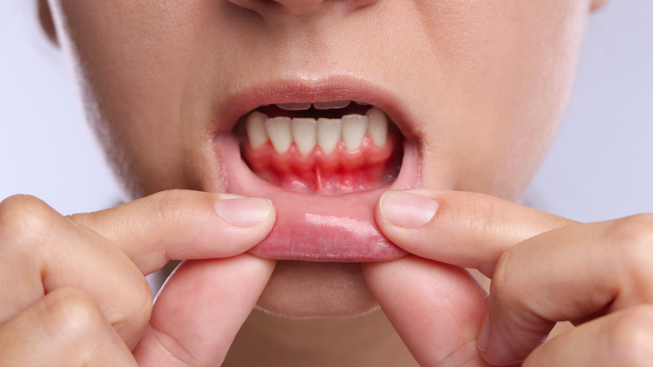 The body check: Why your gums bleed while brushing: What your mouth may be trying to tell you