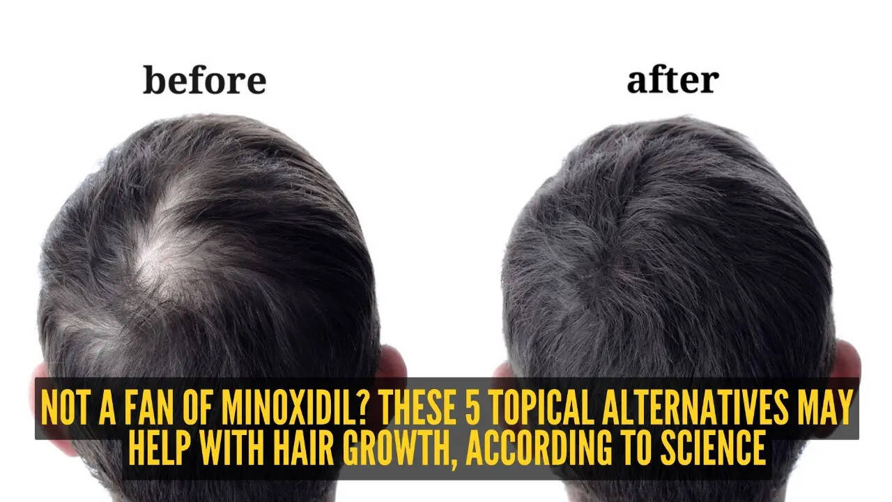 5 topical minoxidil alternatives to increase hair growth
