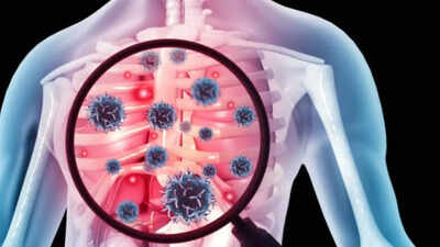 One in three TB cases found in Northeast screening had no symptoms | India News