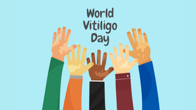 Vitiligo is not contagious: Dermatologist urges people to look beyond the skin this World Vitiligo Day |
