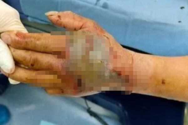 A 72-year-old man in China cut off a cobra’s head and picked it up five minutes later; it bit his palm, and doctors spent two months saving his hand