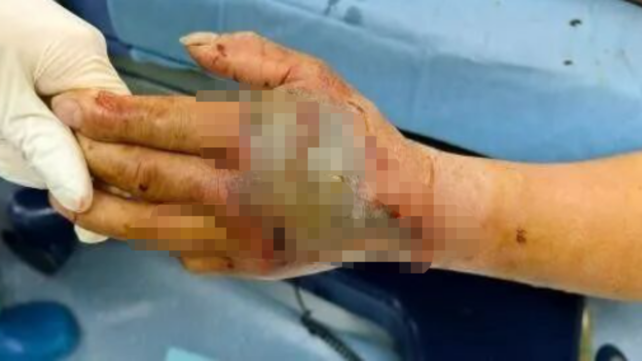 A 72-year-old man in China cut off a cobra’s head and picked it up five minutes later; it bit his palm, and doctors spent two months saving his hand