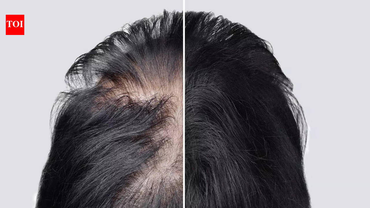 Losing hair because of Alopecia? This Arthritis drug can help you regrow hair like never before |