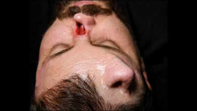 Iraqi surgeon grows nose on patient's forehead in rare reconstruction surgery to correct facial damage in high-voltage electrical accident