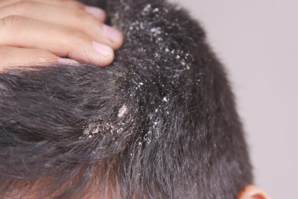 5 hair oils that may be making your dandruff worse