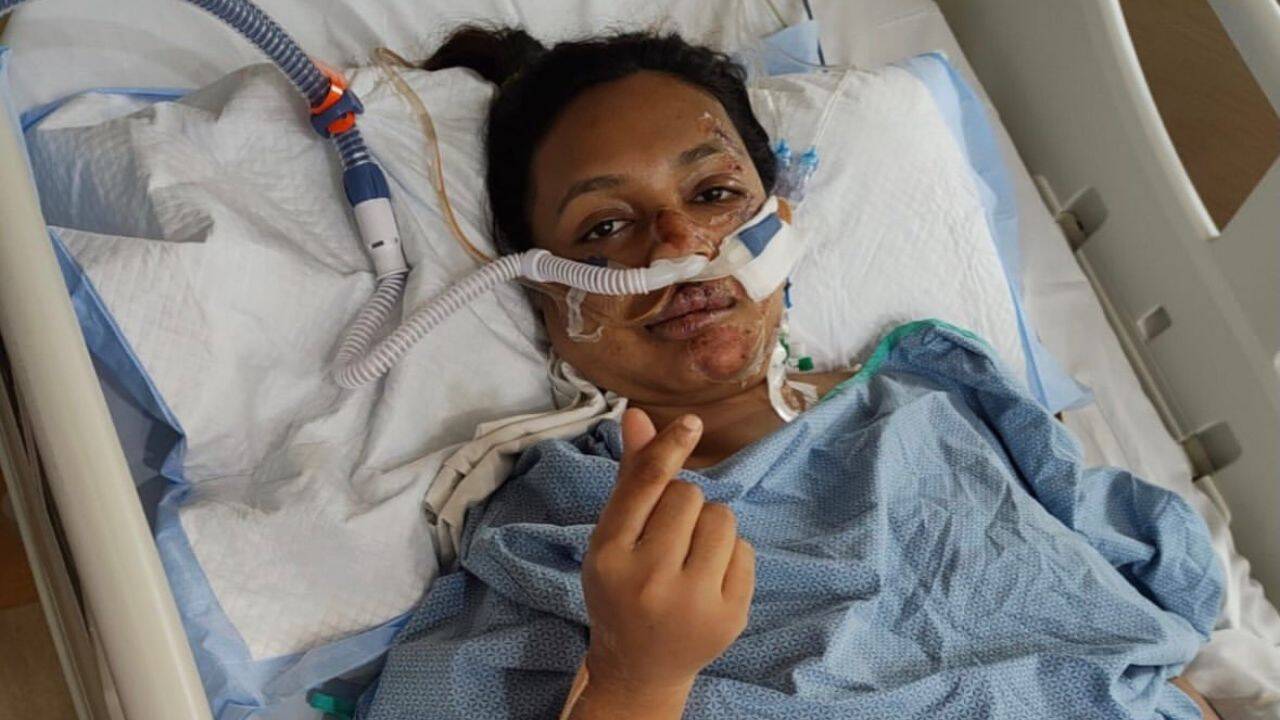 'I told him to drive slowly, but he kept...': A woman booked a bike ride to work and woke up with 9 broken ribs, no spleen, and a company that never called back